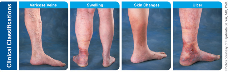 Clinical manifestations venous stasis ulcer
